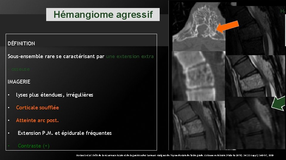 Hémangiome agressif DÉFINITION Sous-ensemble rare se caractérisant par une extension extra - osseuse IMAGERIE Hémangiome agressif DÉFINITION Sous-ensemble rare se caractérisant par une extension extra - osseuse IMAGERIE