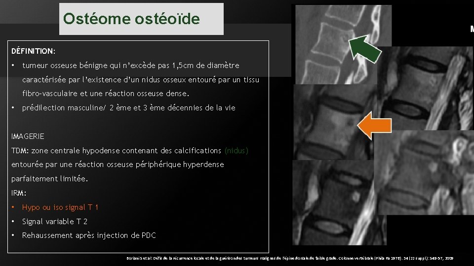 Ostéome ostéoïde DÉFINITION: • tumeur osseuse bénigne qui n’excède pas 1, 5 cm de Ostéome ostéoïde DÉFINITION: • tumeur osseuse bénigne qui n’excède pas 1, 5 cm de