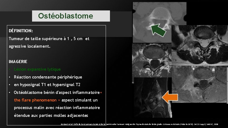 Ostéoblastome DÉFINITION: Tumeur de taille supérieure à 1 , 5 cm et agressive localement. Ostéoblastome DÉFINITION: Tumeur de taille supérieure à 1 , 5 cm et agressive localement.