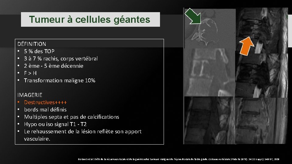 Tumeur à cellules géantes DÉFINITION • 5 % des TOP • 3 à 7 Tumeur à cellules géantes DÉFINITION • 5 % des TOP • 3 à 7