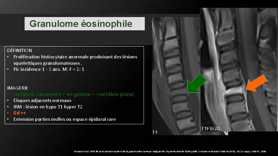 Granulome éosinophile DÉFINITION • Prolifération histiocytaire anormale produisant des lésions squelettiques granulomateuses. • Pic Granulome éosinophile DÉFINITION • Prolifération histiocytaire anormale produisant des lésions squelettiques granulomateuses. • Pic