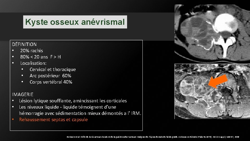 Kyste osseux anévrismal DÉFINITION • 20% rachis • 80% < 20 ans F > Kyste osseux anévrismal DÉFINITION • 20% rachis • 80% < 20 ans F >
