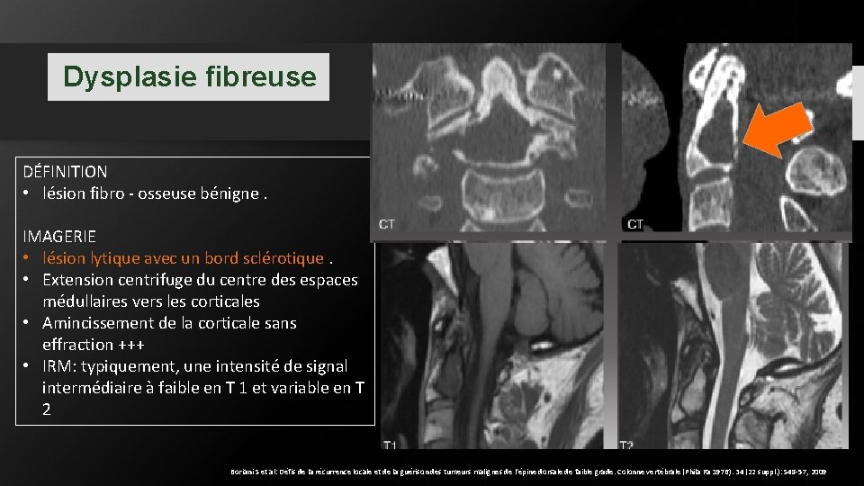 Dysplasie fibreuse DÉFINITION • lésion fibro - osseuse bénigne. IMAGERIE • lésion lytique avec Dysplasie fibreuse DÉFINITION • lésion fibro - osseuse bénigne. IMAGERIE • lésion lytique avec
