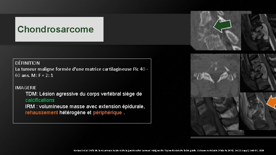 Chondrosarcome DÉFINITION La tumeur maligne formée d'une matrice cartilagineuse Pic 40 60 ans. M: Chondrosarcome DÉFINITION La tumeur maligne formée d'une matrice cartilagineuse Pic 40 60 ans. M: