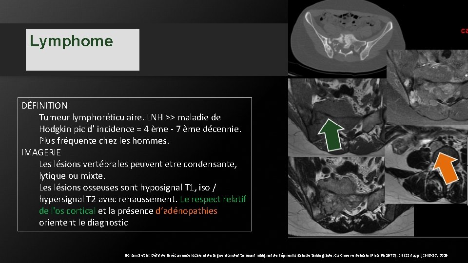 Lymphome DÉFINITION Tumeur lymphoréticulaire. LNH >> maladie de Hodgkin pic d' incidence = 4 Lymphome DÉFINITION Tumeur lymphoréticulaire. LNH >> maladie de Hodgkin pic d' incidence = 4