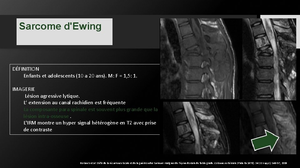 Sarcome d'Ewing DÉFINITION Enfants et adolescents (10 a 20 ans). M: F = 1, Sarcome d'Ewing DÉFINITION Enfants et adolescents (10 a 20 ans). M: F = 1,