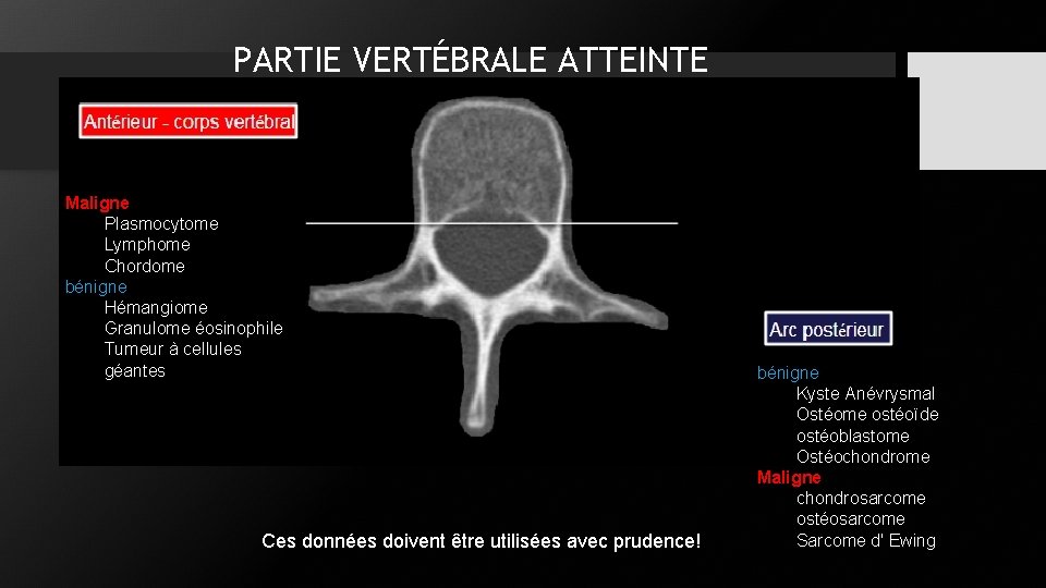 PARTIE VERTÉBRALE ATTEINTE Maligne Plasmocytome Lymphome Chordome bénigne Hémangiome Granulome éosinophile Tumeur à cellules PARTIE VERTÉBRALE ATTEINTE Maligne Plasmocytome Lymphome Chordome bénigne Hémangiome Granulome éosinophile Tumeur à cellules