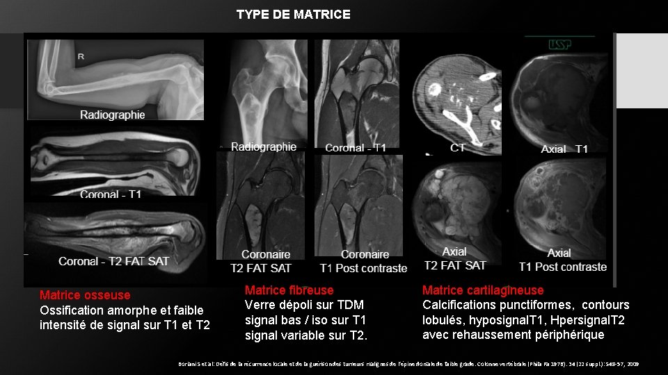 TYPE DE MATRICE Matrice osseuse Ossification amorphe et faible intensité de signal sur T TYPE DE MATRICE Matrice osseuse Ossification amorphe et faible intensité de signal sur T