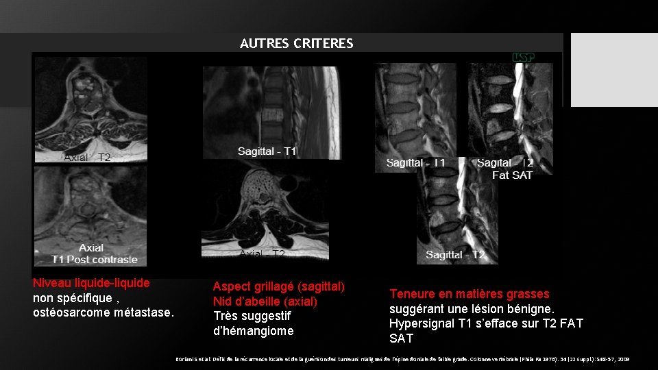 AUTRES CRITERES Niveau liquide-liquide non spécifique , ostéosarcome métastase. Aspect grillagé (sagittal) Nid d’abeille AUTRES CRITERES Niveau liquide-liquide non spécifique , ostéosarcome métastase. Aspect grillagé (sagittal) Nid d’abeille