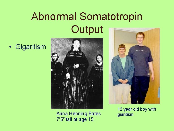 Abnormal Somatotropin Output • Gigantism Anna Henning Bates 7’ 5” tall at age 15