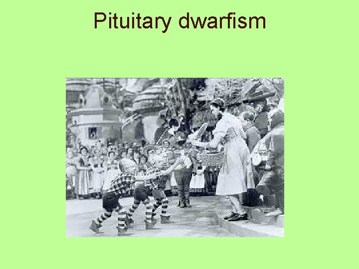 Pituitary dwarfism 