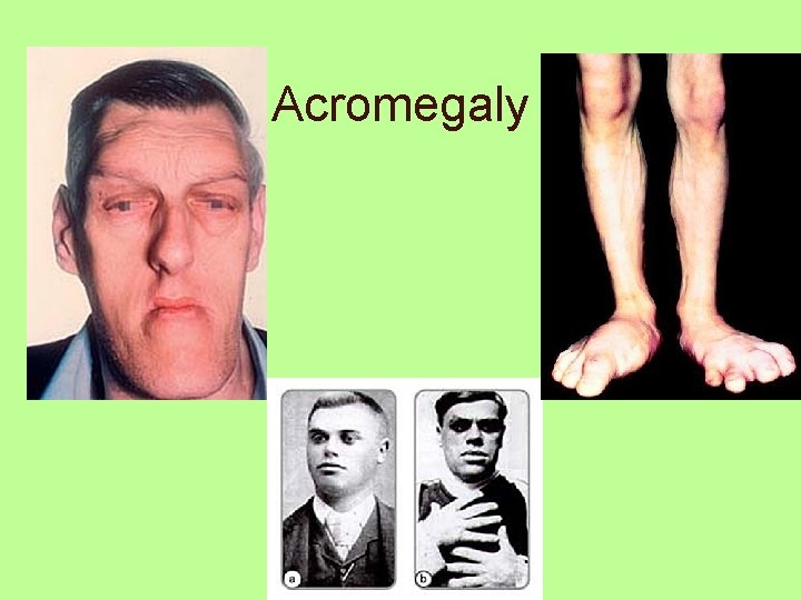 Acromegaly 
