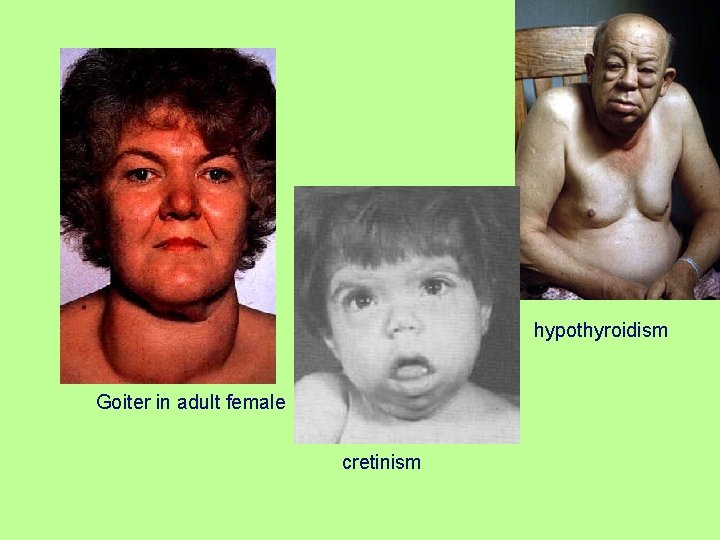 hypothyroidism Goiter in adult female cretinism 