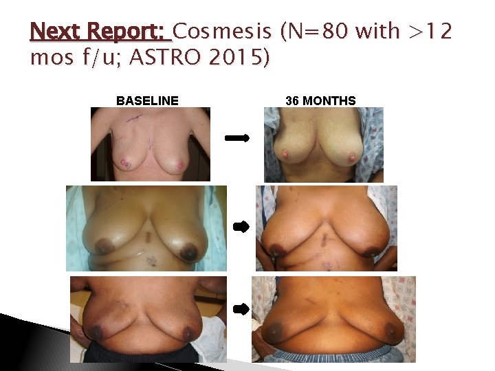 Next Report: Cosmesis (N=80 with >12 mos f/u; ASTRO 2015) BASELINE 36 MONTHS 