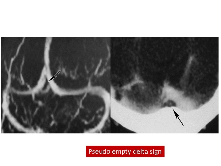 Pseudo empty delta sign 