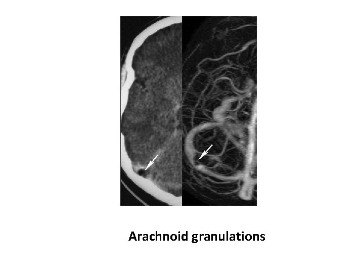 Arachnoid granulations 