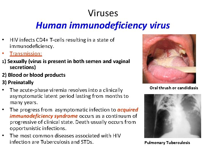 Viruses Human immunodeficiency virus • HIV infects CD 4+ T-cells resulting in a state