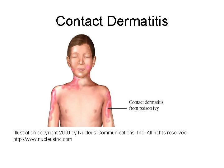 Contact Dermatitis Illustration copyright 2000 by Nucleus Communications, Inc. All rights reserved. http: //www.