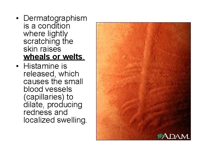  • Dermatographism is a condition where lightly scratching the skin raises wheals or
