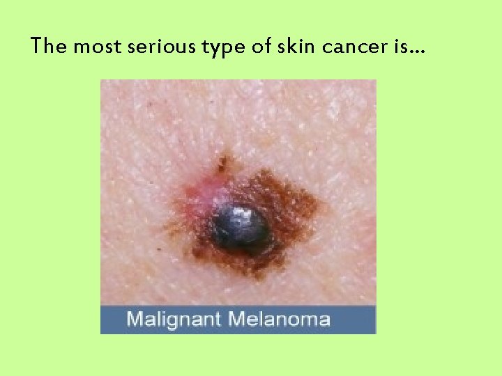 The most serious type of skin cancer is… 