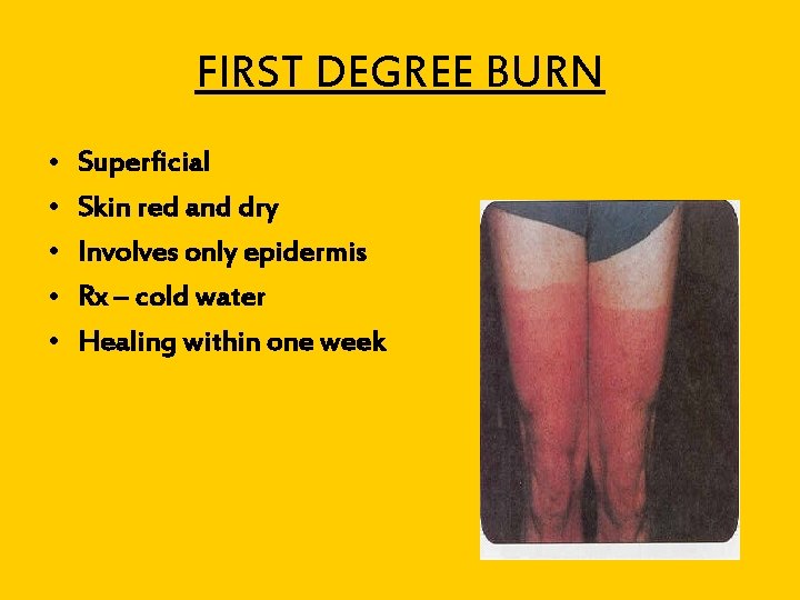 FIRST DEGREE BURN • • • Superficial Skin red and dry Involves only epidermis