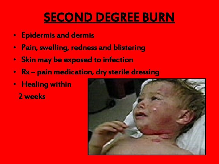 SECOND DEGREE BURN • • • Epidermis and dermis Pain, swelling, redness and blistering