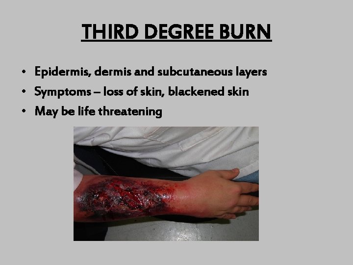 THIRD DEGREE BURN • Epidermis, dermis and subcutaneous layers • Symptoms – loss of