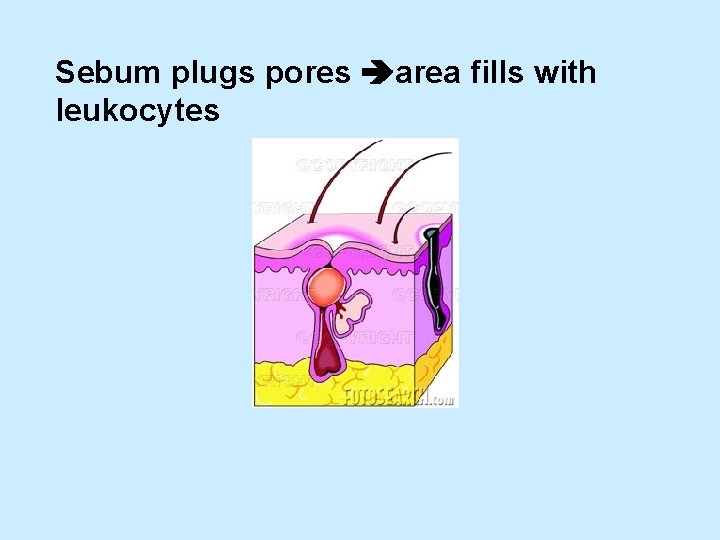 Sebum plugs pores area fills with leukocytes 