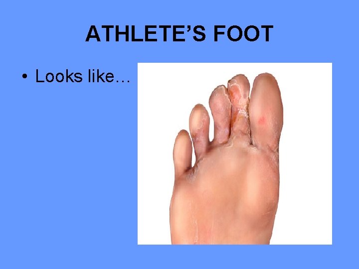 ATHLETE’S FOOT • Looks like… 