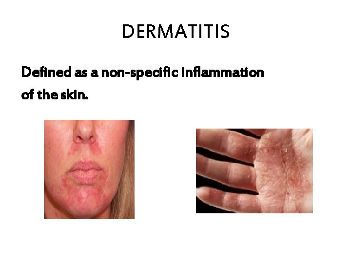 DERMATITIS Defined as a non-specific inflammation of the skin. 