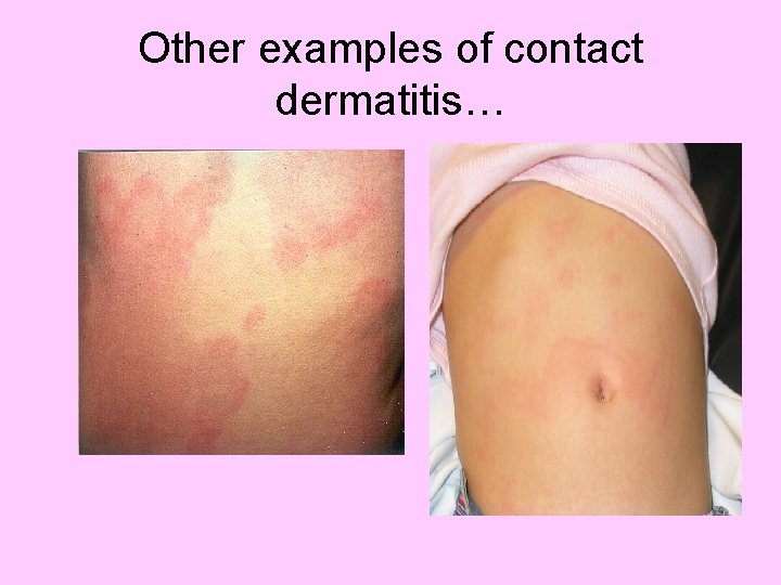 Other examples of contact dermatitis… 