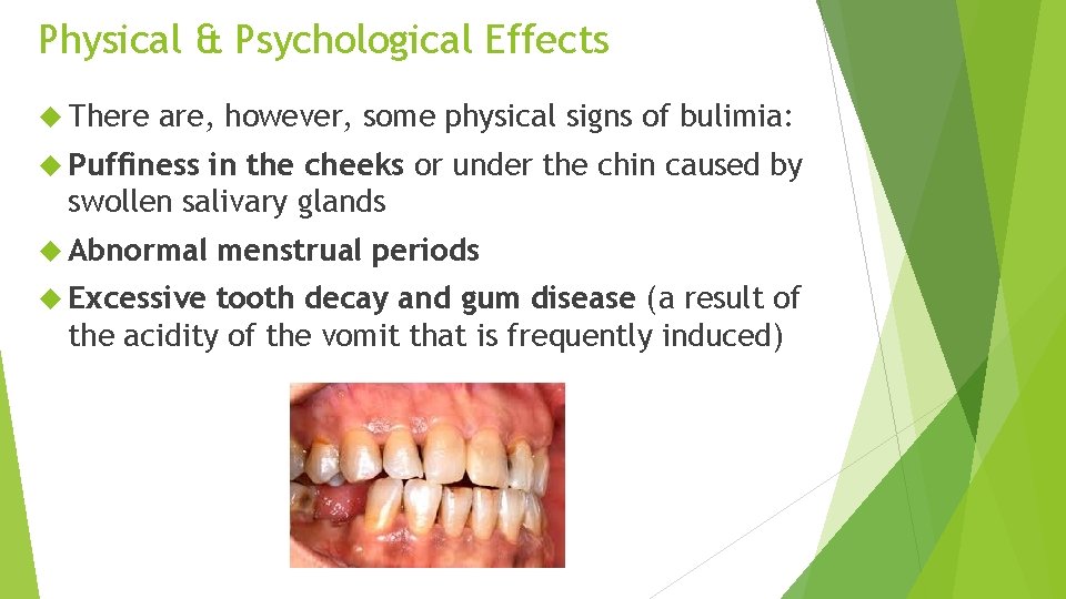 Physical & Psychological Effects There are, however, some physical signs of bulimia: Puffiness in