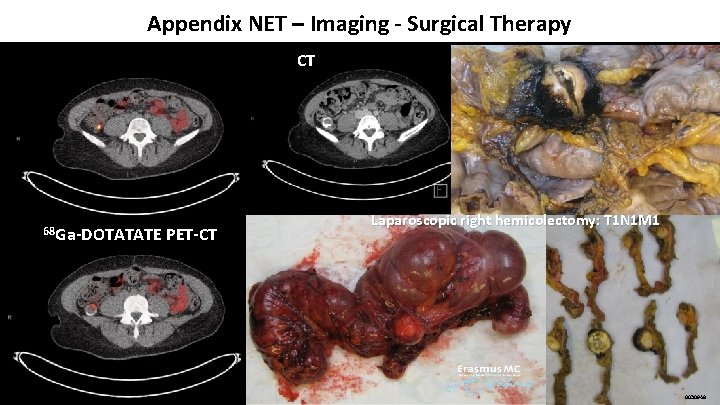 Appendix NET – Imaging - Surgical Therapy CT 68 Ga-DOTATATE PET-CT Laparoscopic right hemicolectomy: