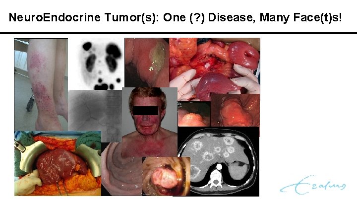 Neuro. Endocrine Tumor(s): One (? ) Disease, Many Face(t)s! 
