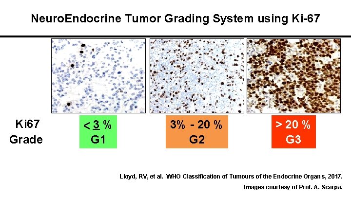 Neuro. Endocrine Tumor Grading System using Ki-67 Ki 67 Grade <3% G 1 3%