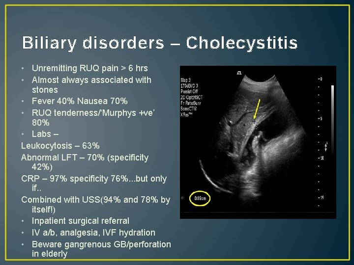Biliary disorders – Cholecystitis • Unremitting RUQ pain > 6 hrs • Almost always