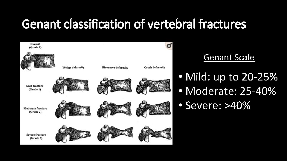 Genant classification of vertebral fractures Genant Scale • Mild: up to 20 -25% •