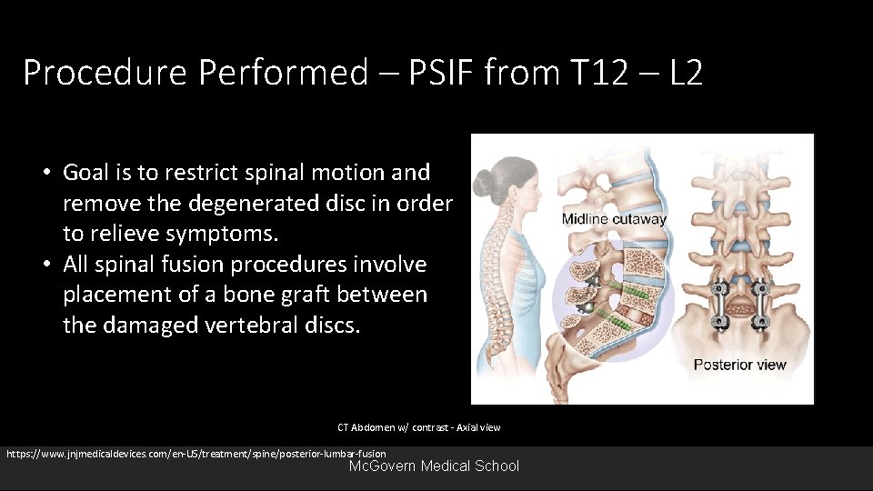 Procedure Performed – PSIF from T 12 – L 2 • Goal is to