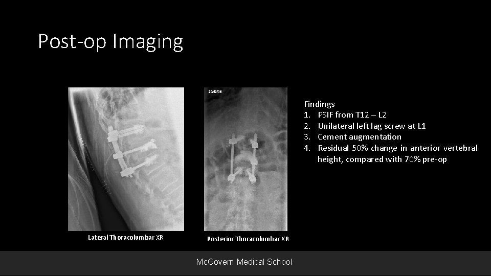 Post-op Imaging Findings 1. PSIF from T 12 – L 2 2. Unilateral left