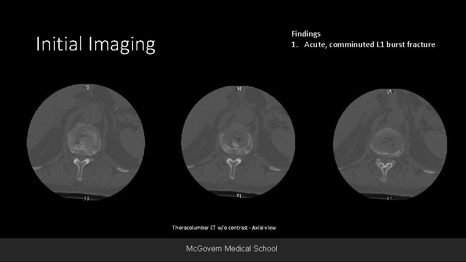 Findings 1. Acute, comminuted L 1 burst fracture Initial Imaging Thoracolumbar CT w/o contrast