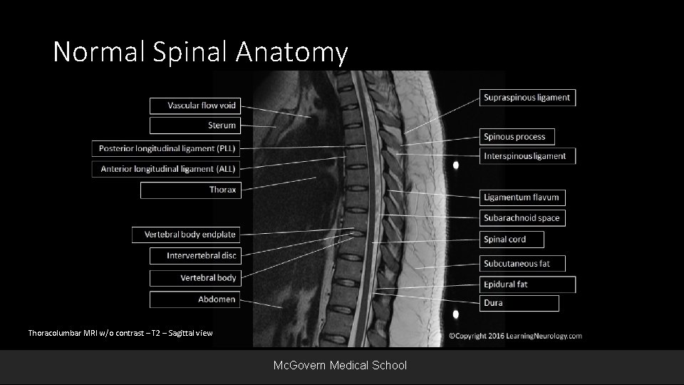 Normal Spinal Anatomy Thoracolumbar MRI w/o contrast – T 2 – Sagittal view Mc.