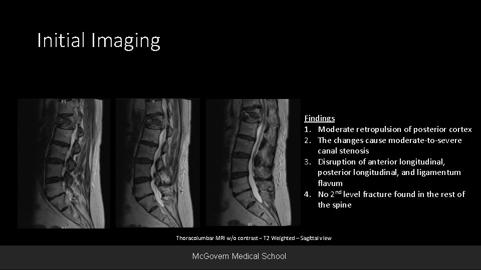 Initial Imaging Findings 1. Moderate retropulsion of posterior cortex 2. The changes cause moderate-to-severe