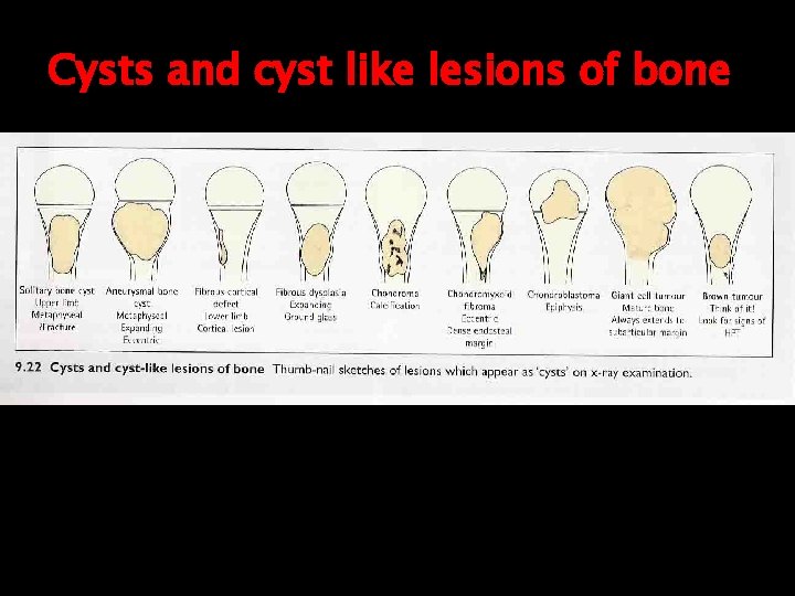 Cysts and cyst like lesions of bone 