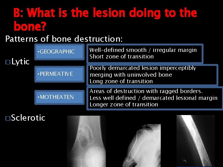 B: What is the lesion doing to the bone? Patterns of bone destruction: �