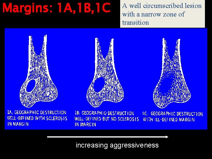 Margins: 1 A, 1 B, 1 C A well circumscribed lesion with a narrow