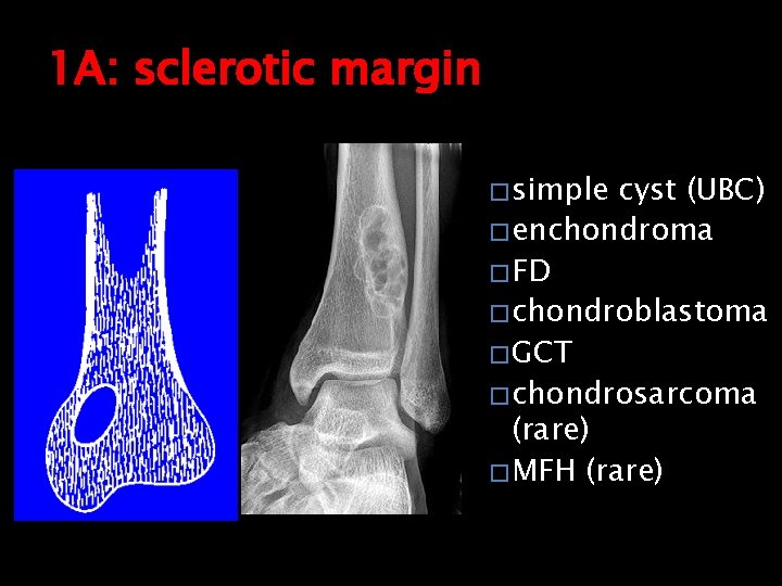 1 A: sclerotic margin � simple cyst (UBC) � enchondroma � FD � chondroblastoma