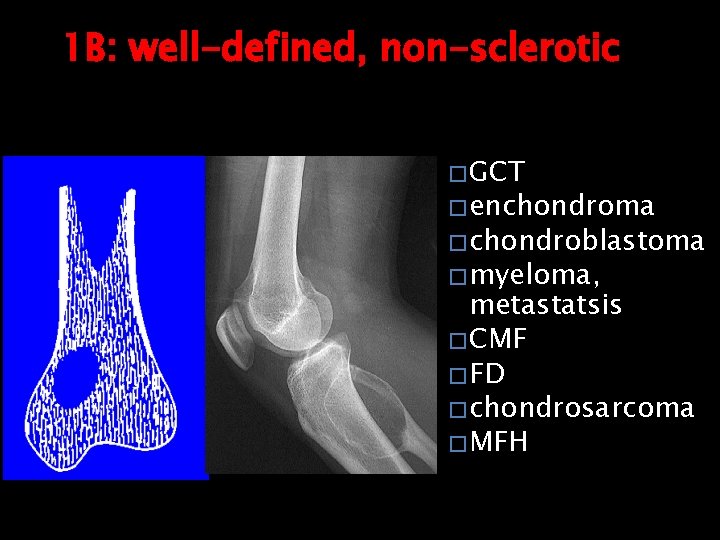 1 B: well-defined, non-sclerotic � GCT � enchondroma � chondroblastoma � myeloma, metastatsis �