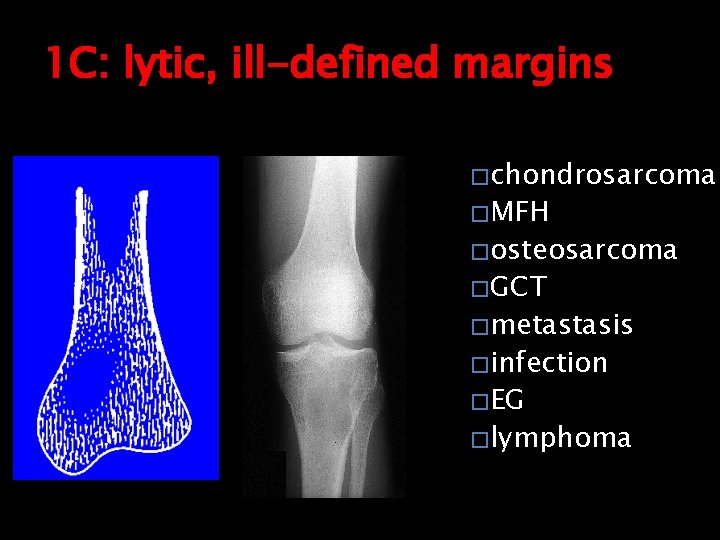 1 C: lytic, ill-defined margins � chondrosarcoma � MFH � osteosarcoma � GCT �
