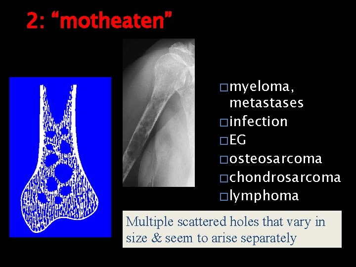 2: “motheaten” � myeloma, metastases � infection � EG � osteosarcoma � chondrosarcoma �