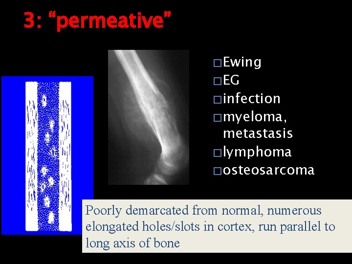 3: “permeative” � Ewing � EG � infection � myeloma, metastasis � lymphoma �
